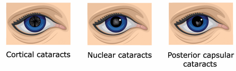 Dilated Pupils eye